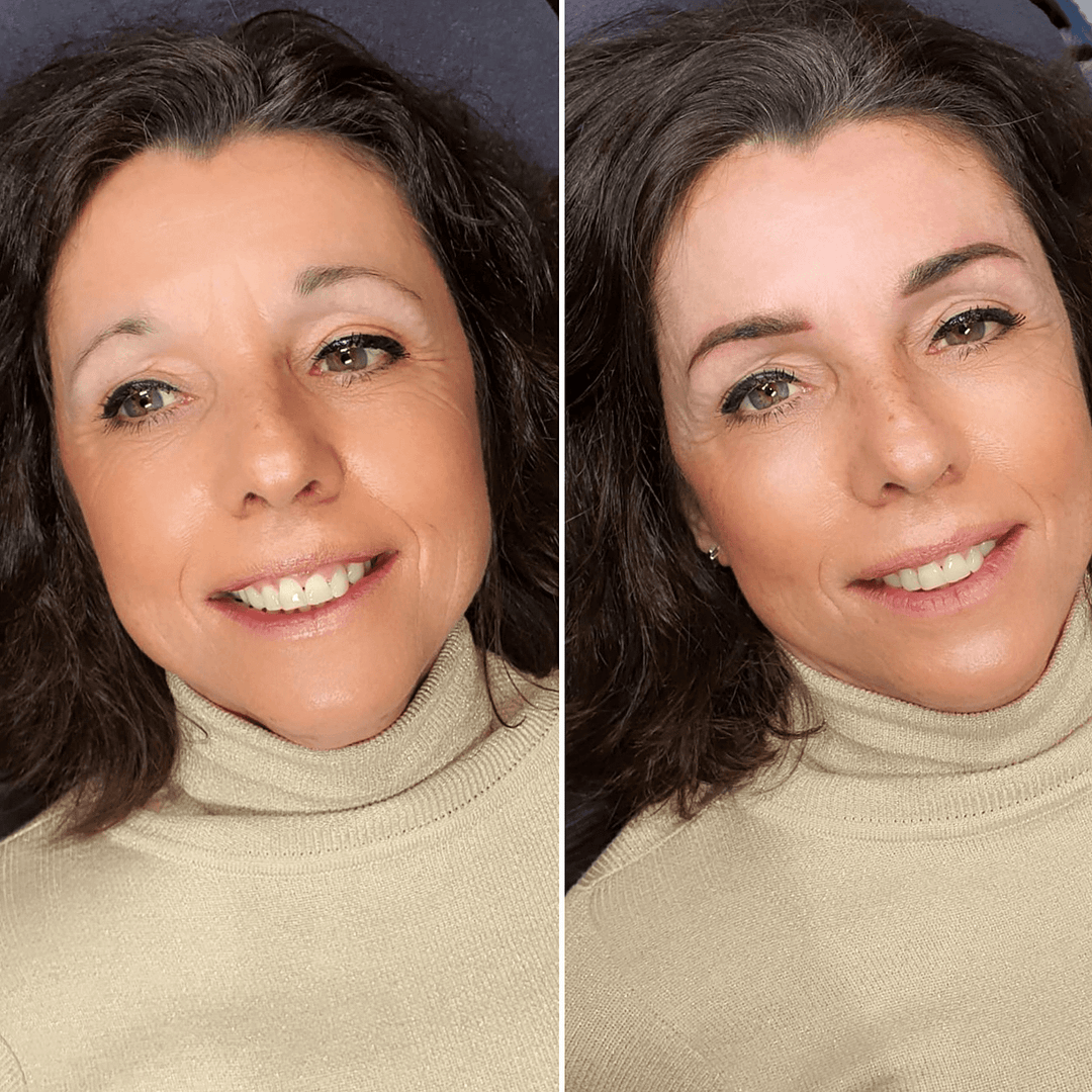 Eyebrow tattoo removal Amsterdam