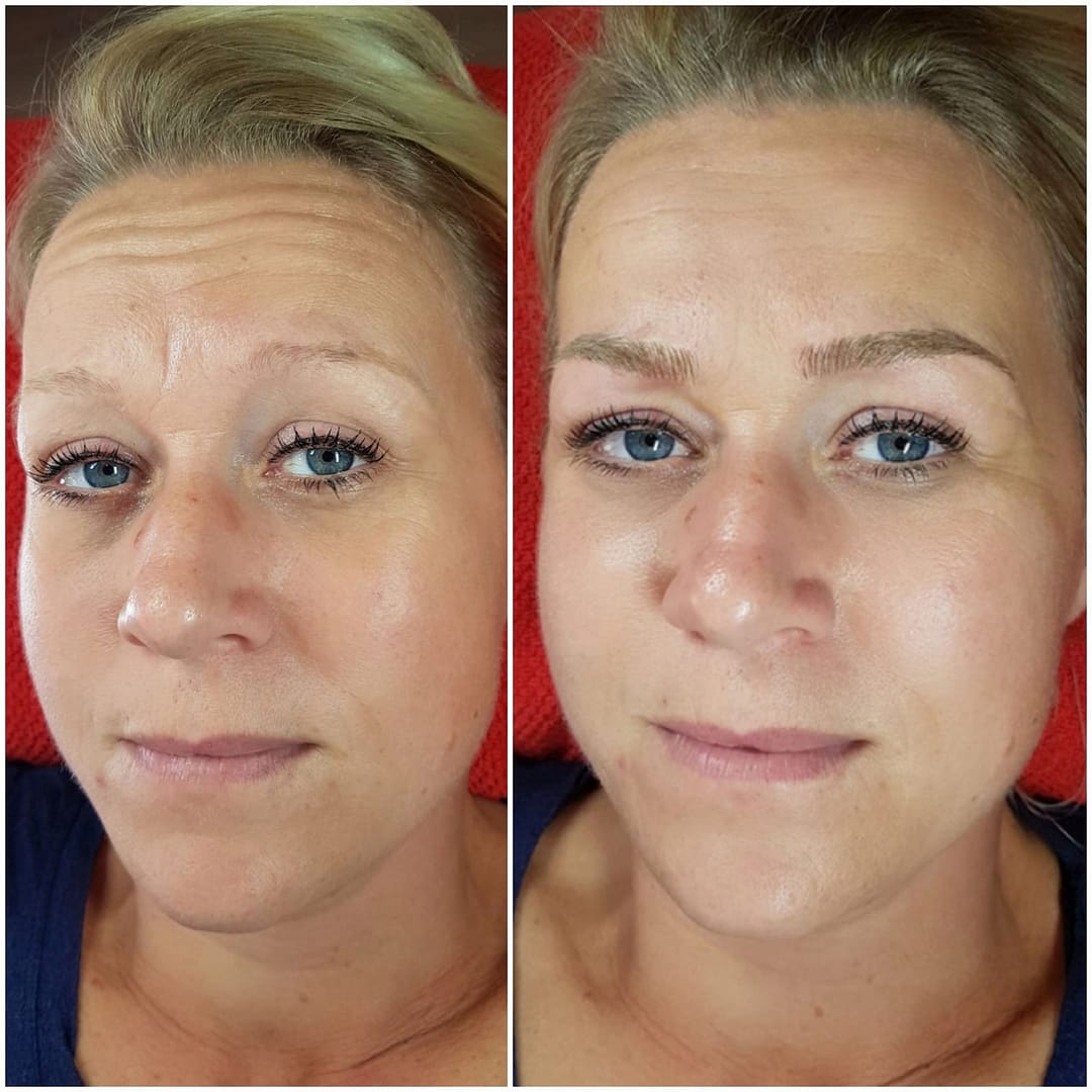 Eyebrow tattoo removal Amsterdam