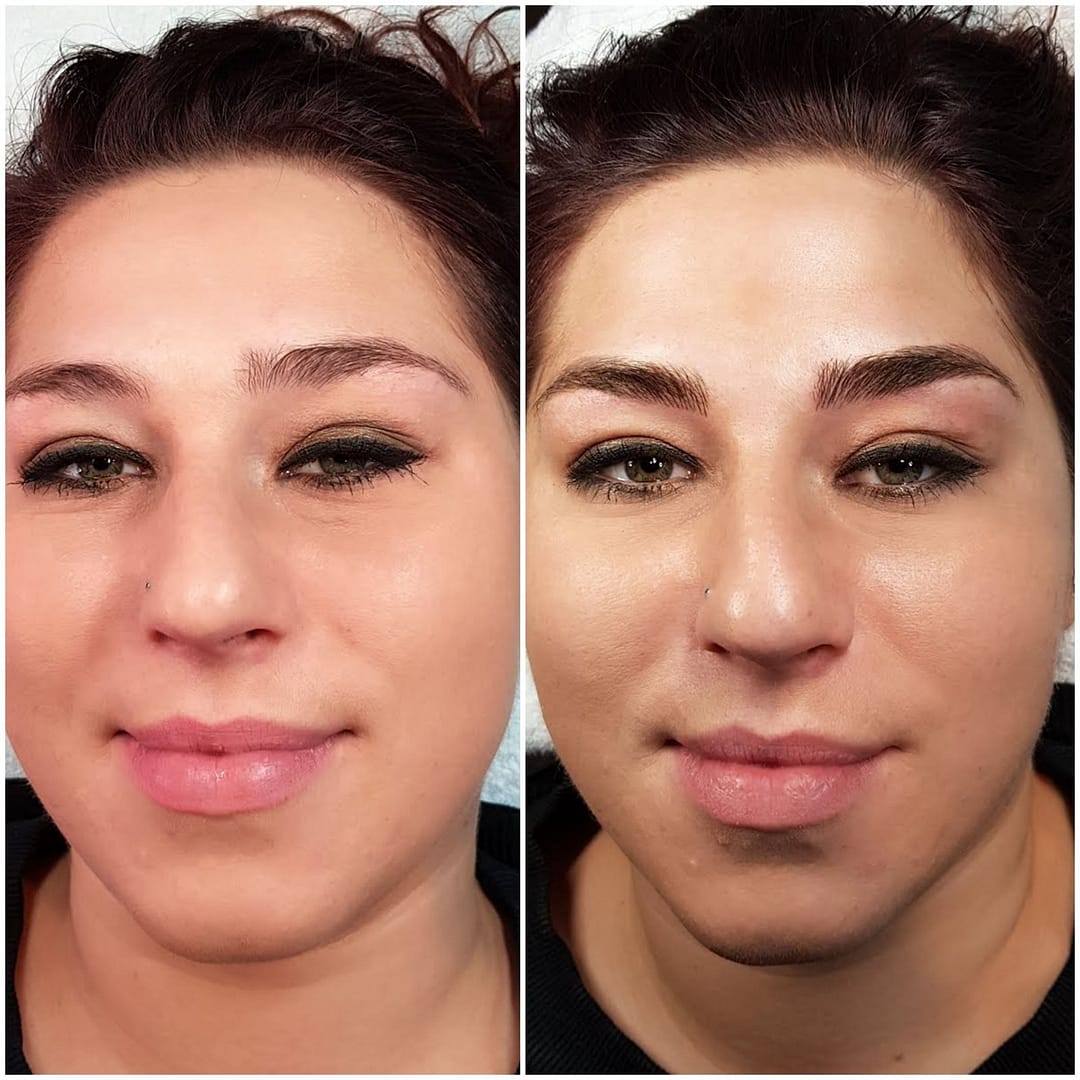 Eyebrow tattoo removal Amsterdam