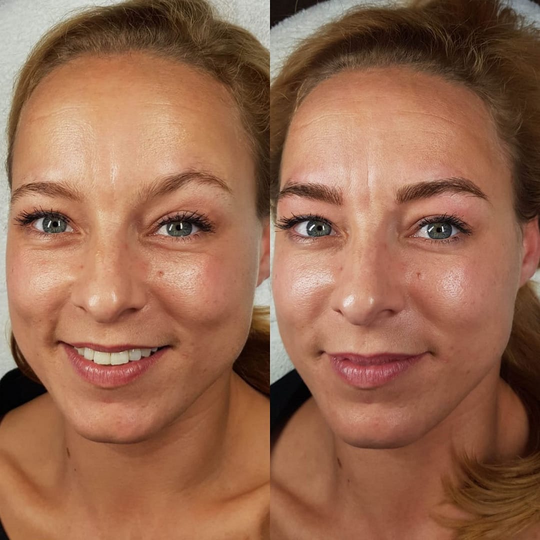 safe tattoo removal amsterdam