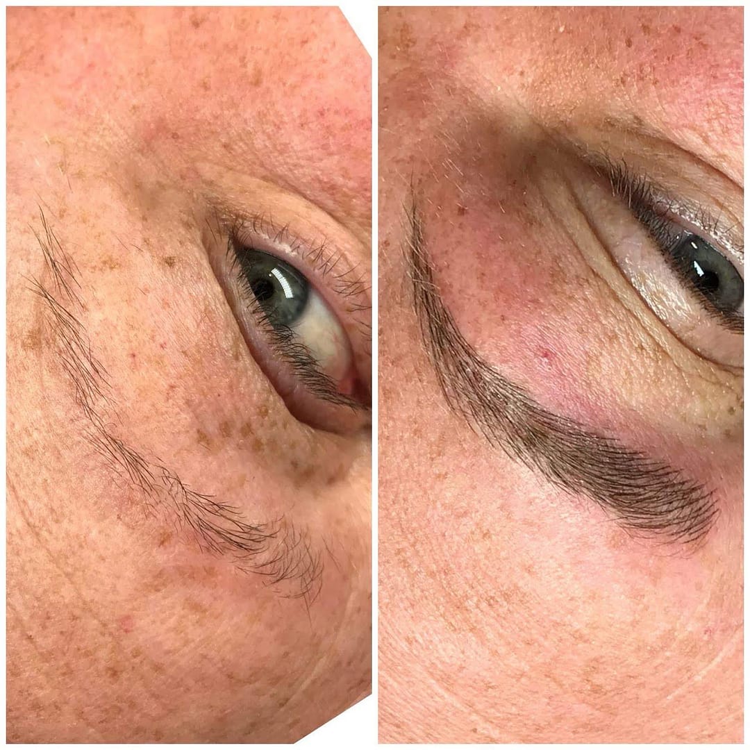 Eyebrow tattoo removal Amsterdam