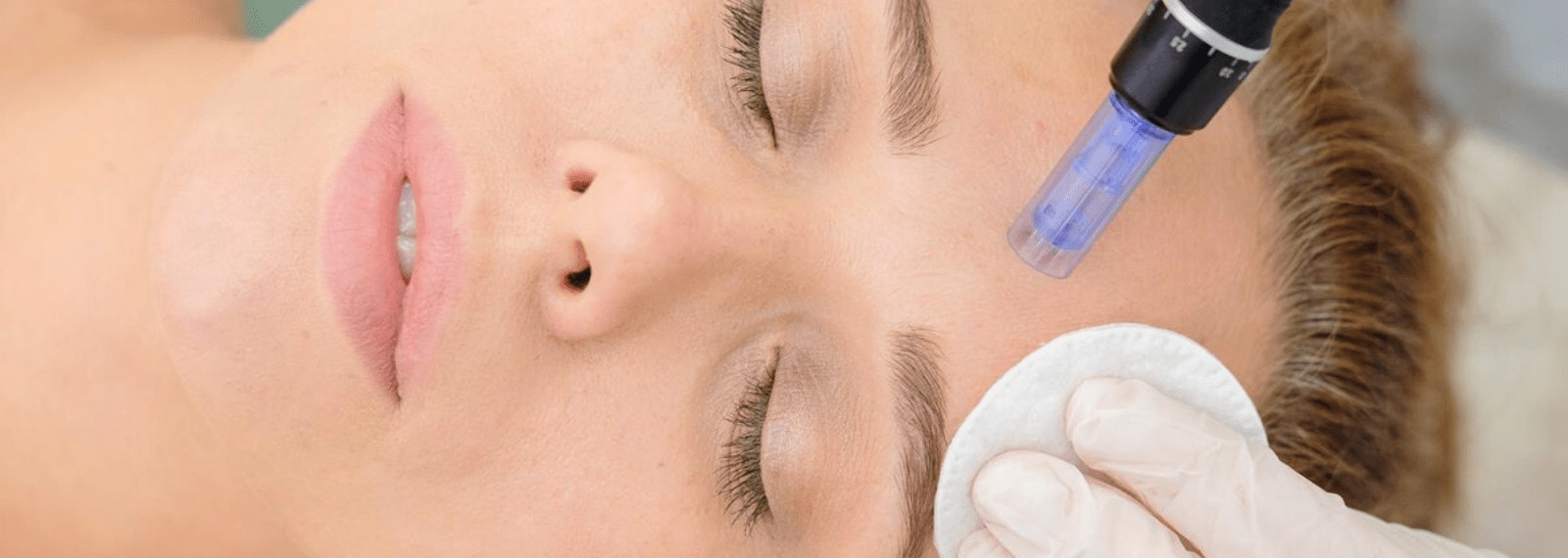 microneedling