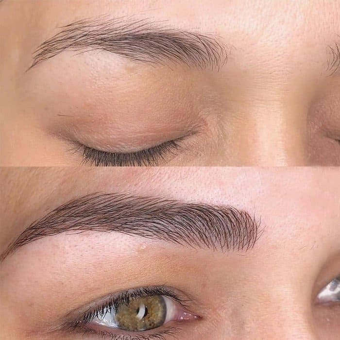 Eyebrow tattoo removal Amsterdam